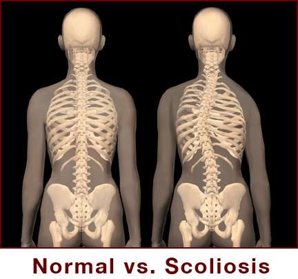 scoliosis2