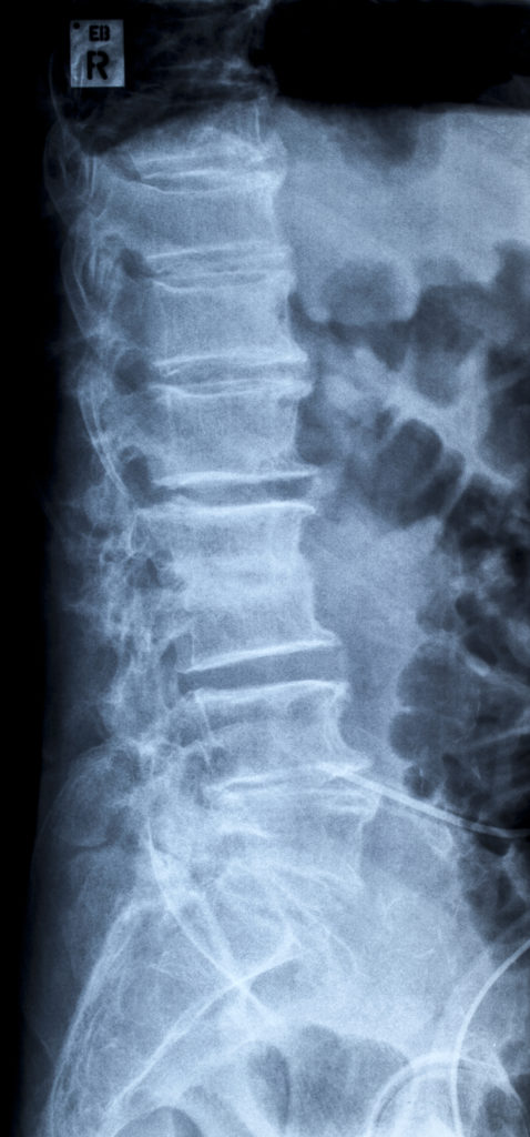 Diagnosing a Disc Injury